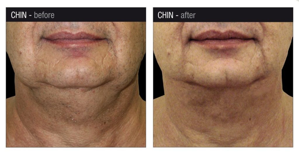Endolift Marbella